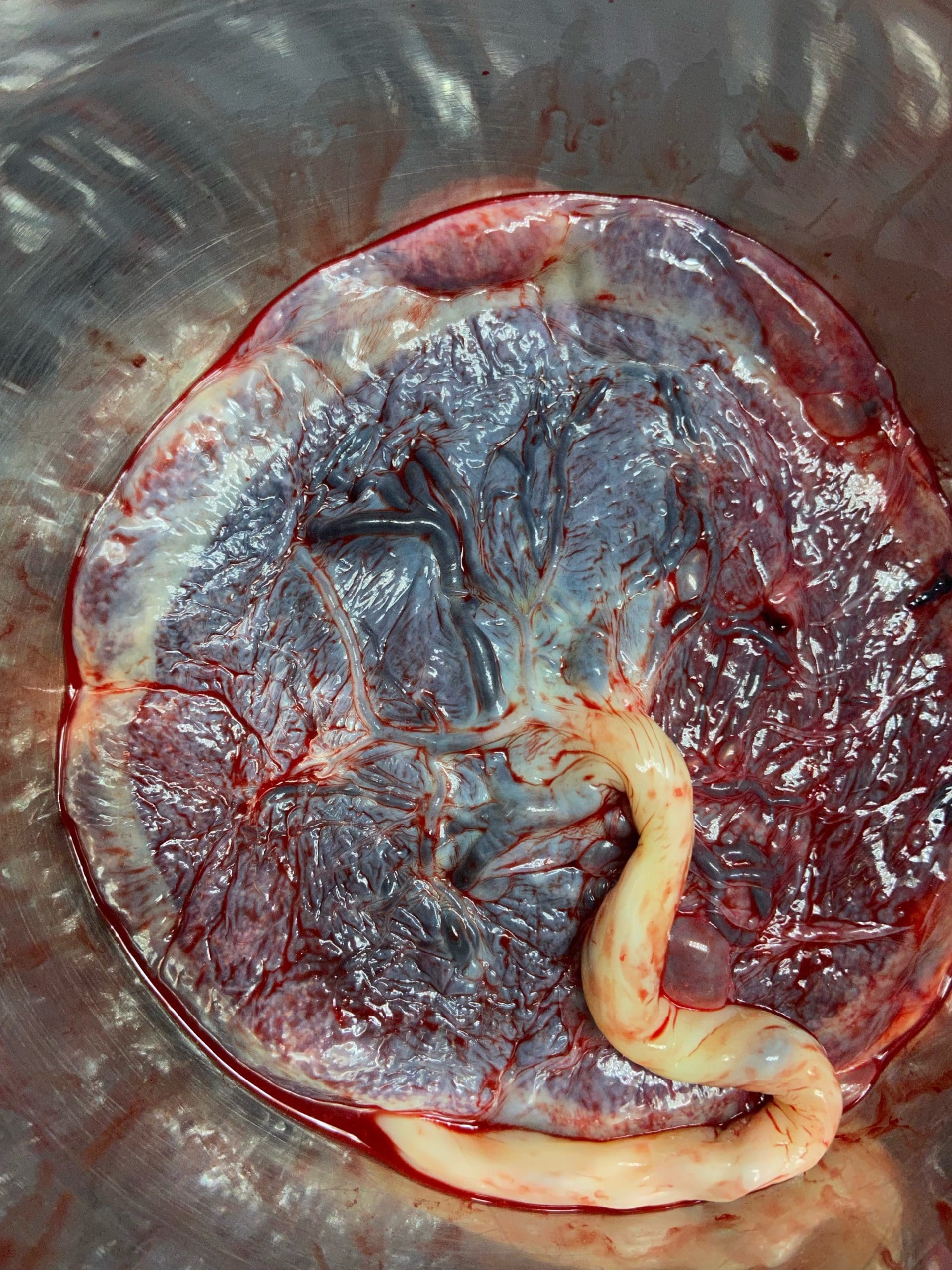 Risks to Placenta Encapsulation