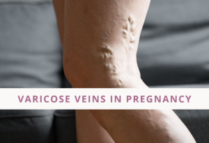 Varicose Veins In Pregnancy