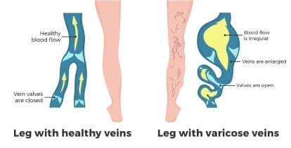 varicose veins in pregnancy from What to Expect When You Are Expecting
